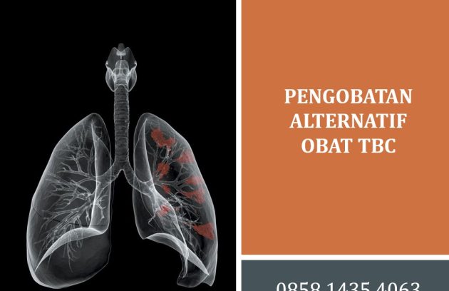 Pengobatan Alternatif Obat TBC