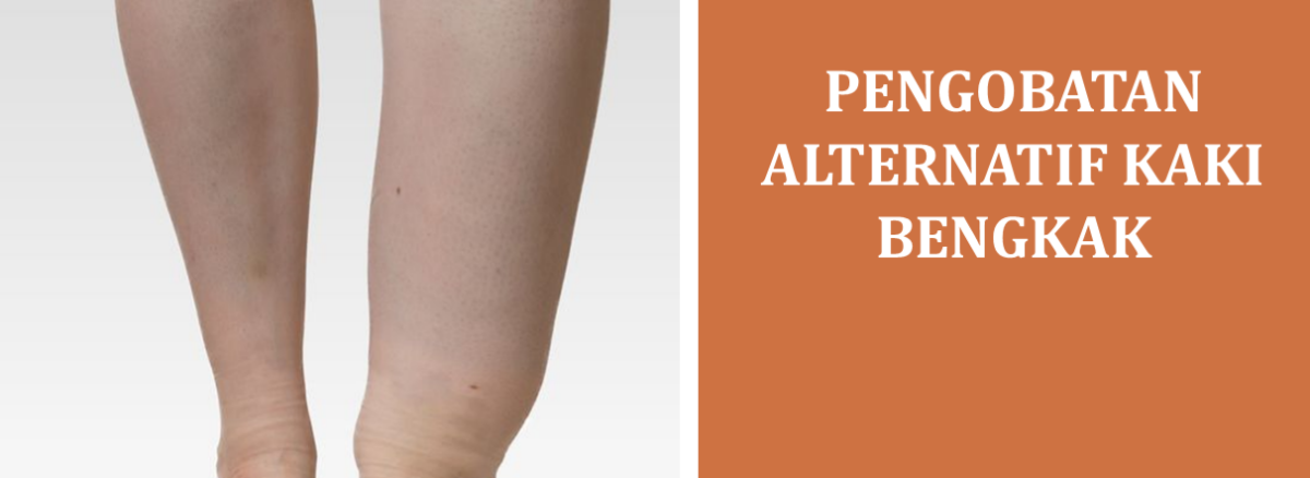 Pengobatan Alternatif Kaki Bengkak