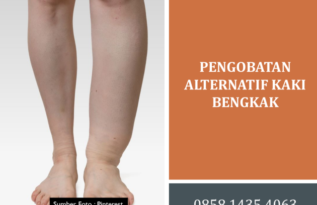 Pengobatan Alternatif Kaki Bengkak