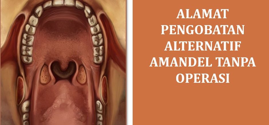Alamat Pengobatan Alternatif Amandel Tanpa Operasi