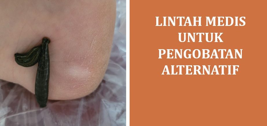 Lintah Medis untuk Pengobatan Alternatif