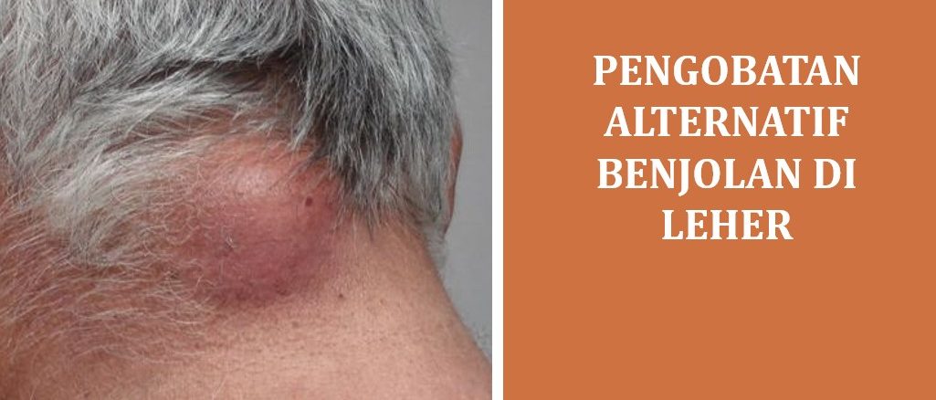Pengobatan Alternatif Benjolan di Leher