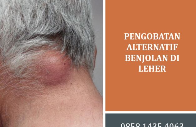 Pengobatan Alternatif Benjolan di Leher